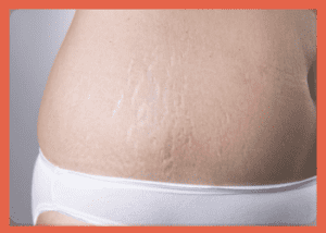 What is stretch mark